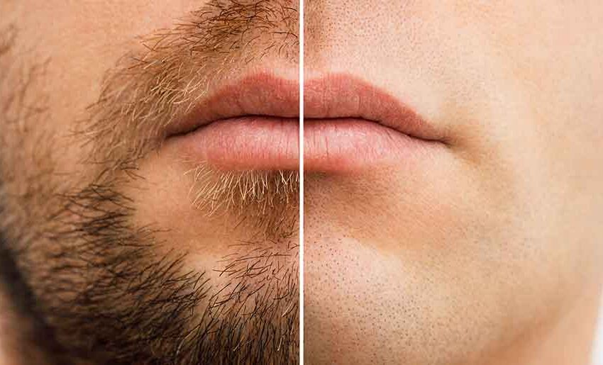 Top 7 Clinics for Laser Hair Removal in Chicago [2025 Edition]