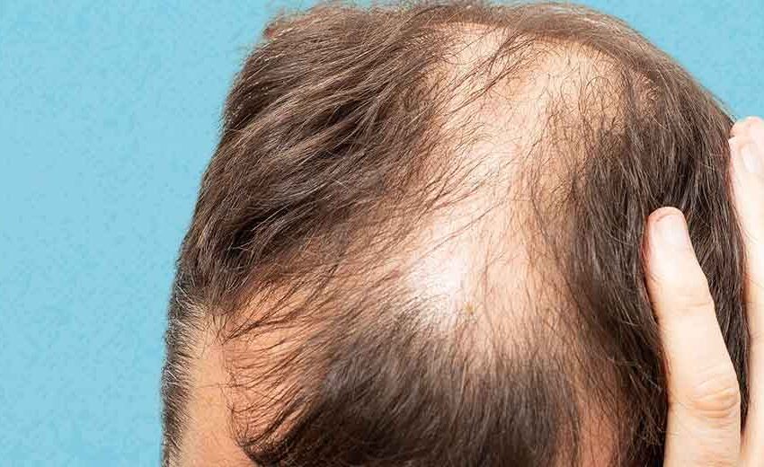  What Health Conditions Are Common Causes of Hair Loss in Men and How They Impact Overall Well-being